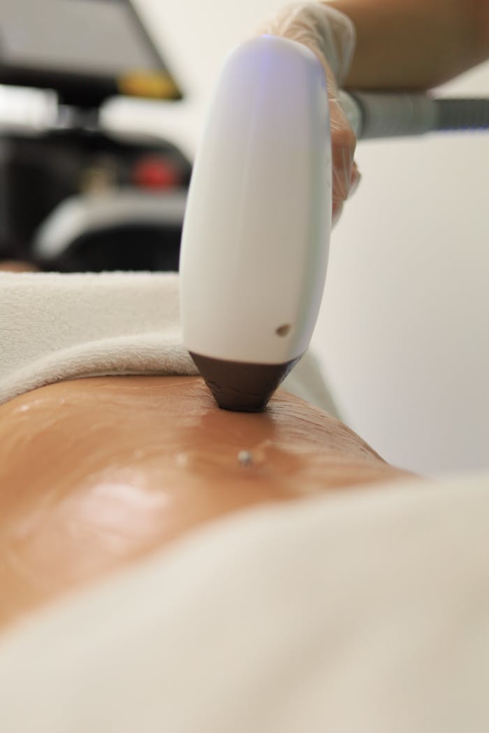 gallery-3 Detailed view of a laser treatment on skin at a medical clinic in İstanbul.